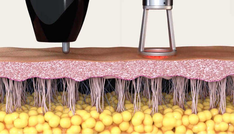 Aesthetic device animation still
