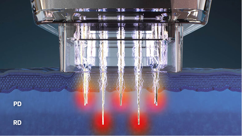 Aesthetic device animation still