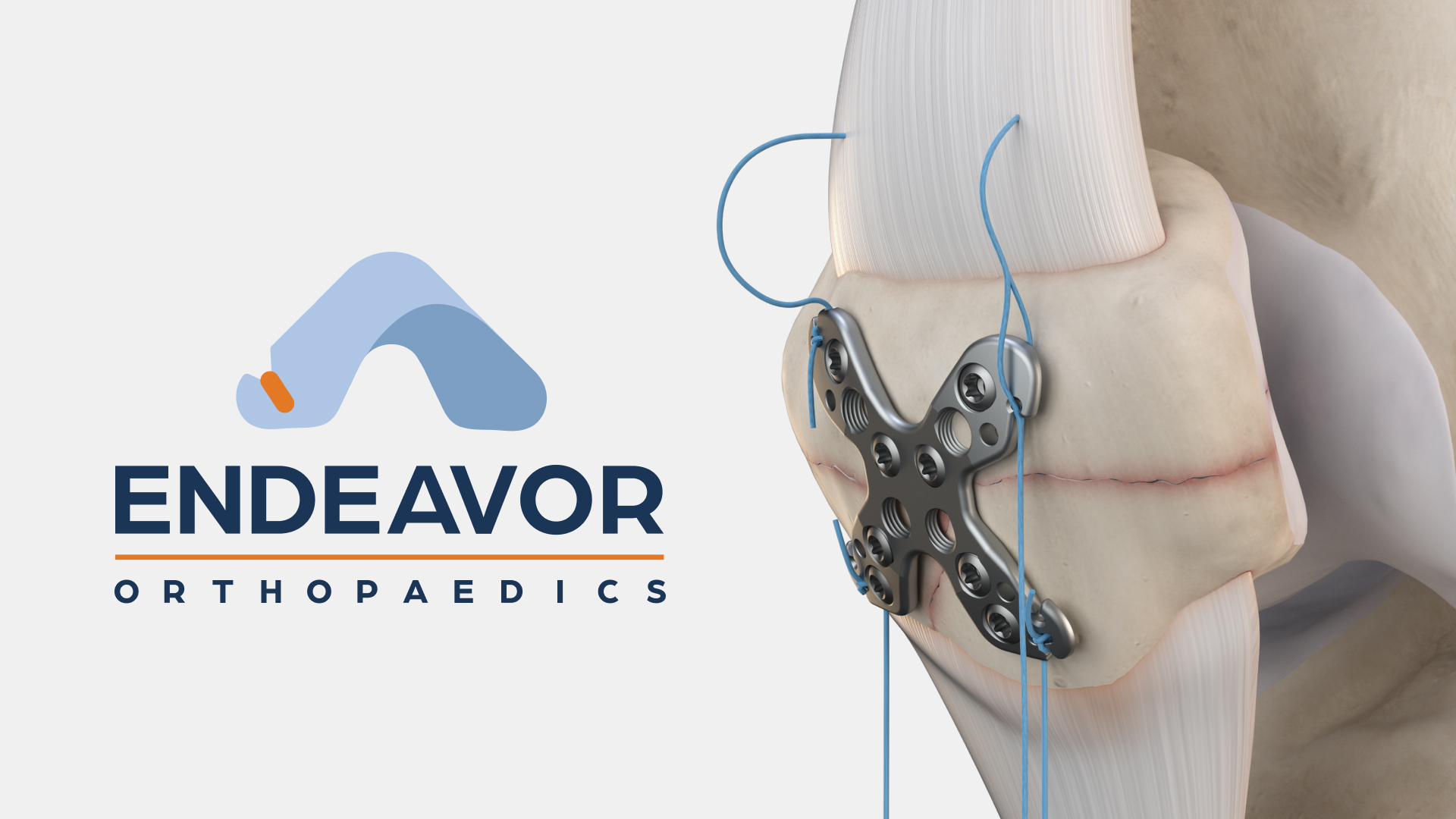 Summit Patella Plating System cover
