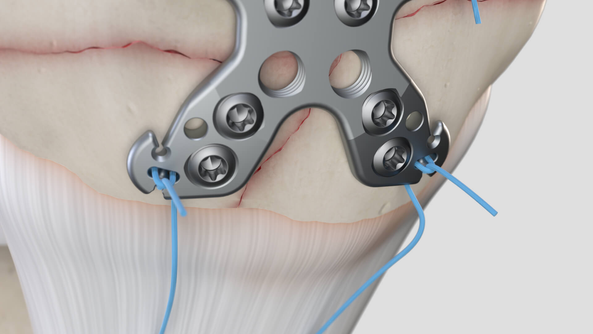 Summit Patella asset library still 01