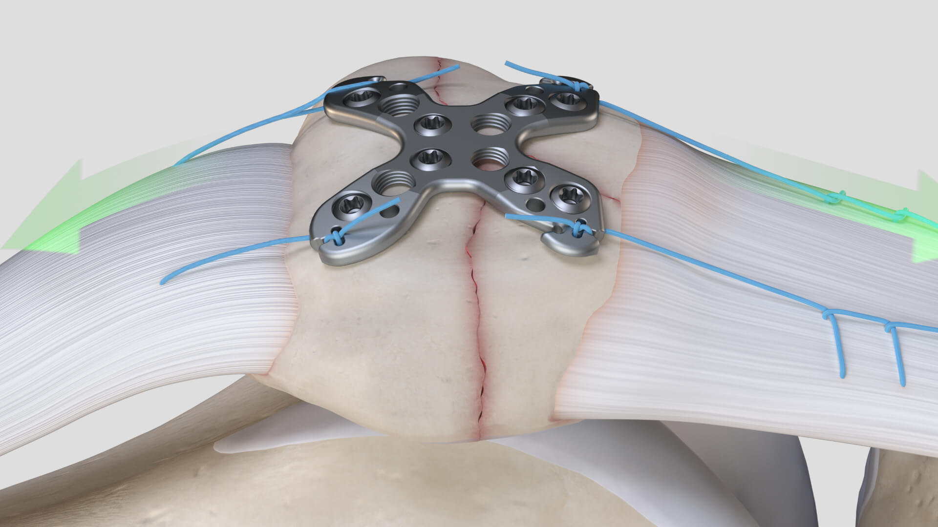 Summit Patella asset library still 02