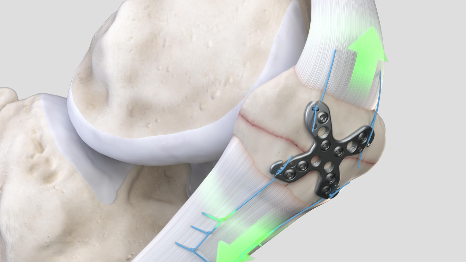 The Summit Patella Plating System with integrated suture path