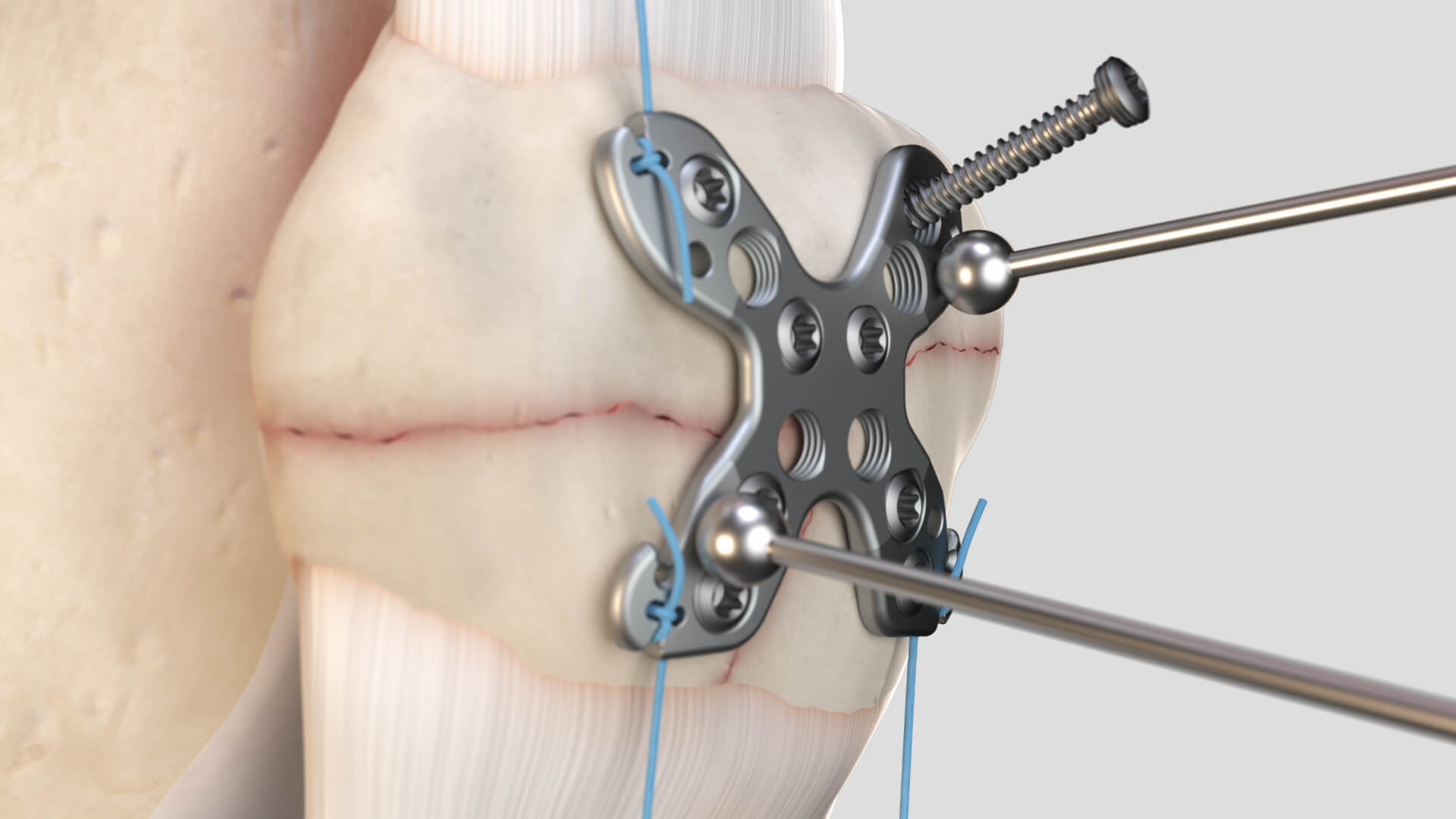 Summit Patella asset library still 05