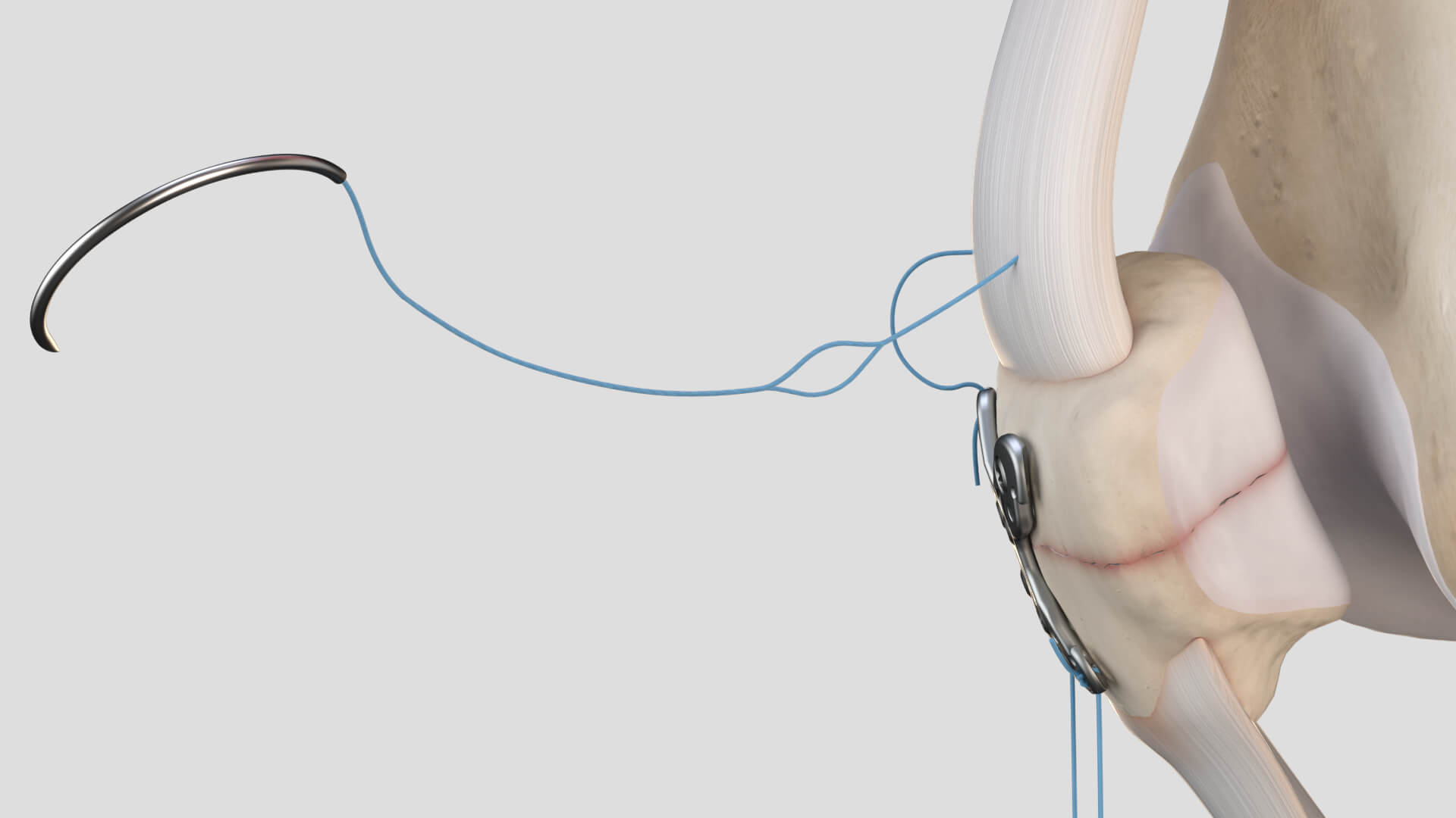 Summit Patella asset library still 06