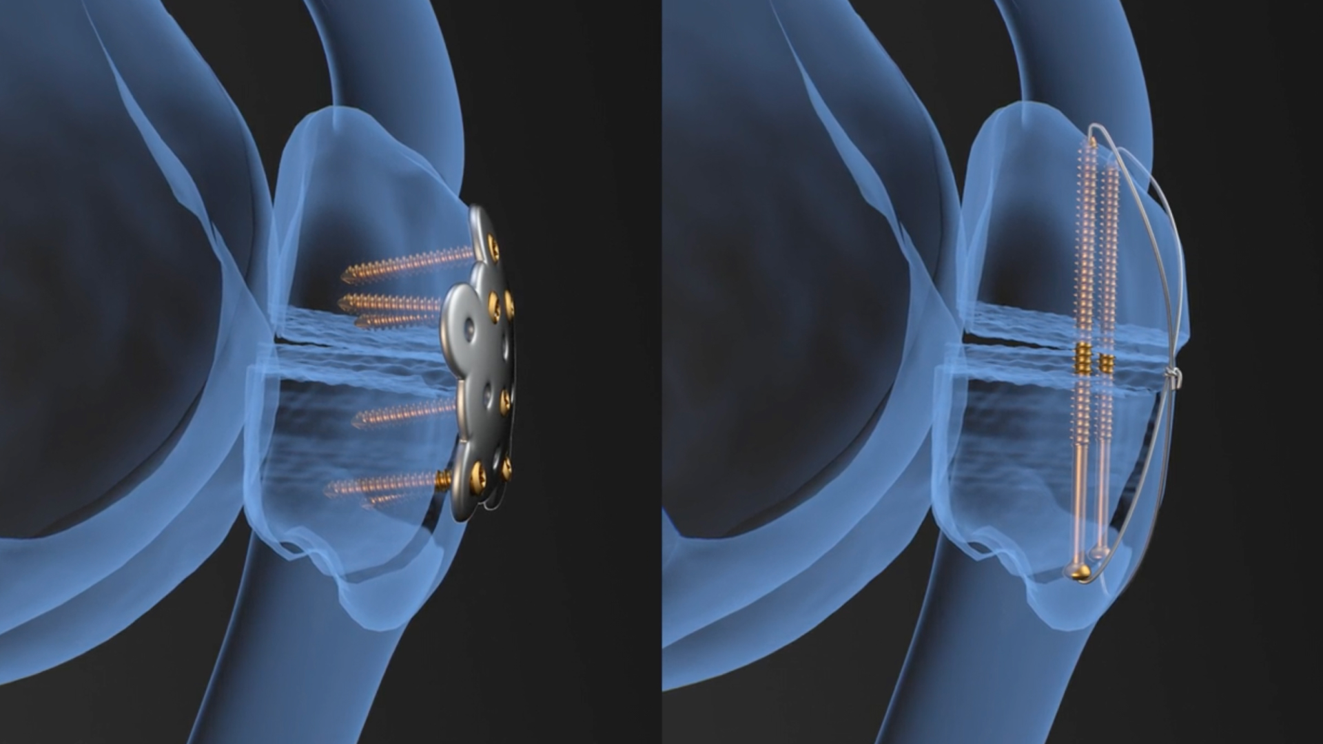 Traditional fixation, holding bone under quadriceps load