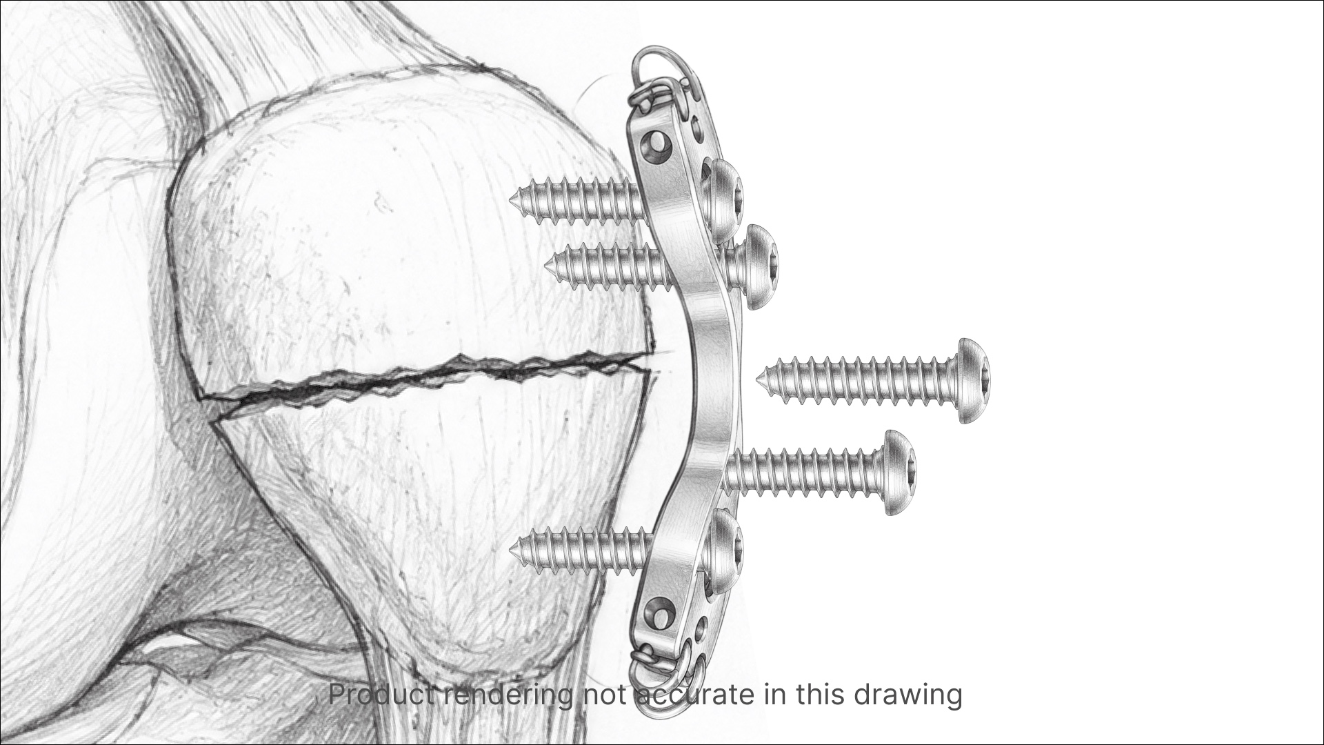 Summit Patella storyboard frame 11